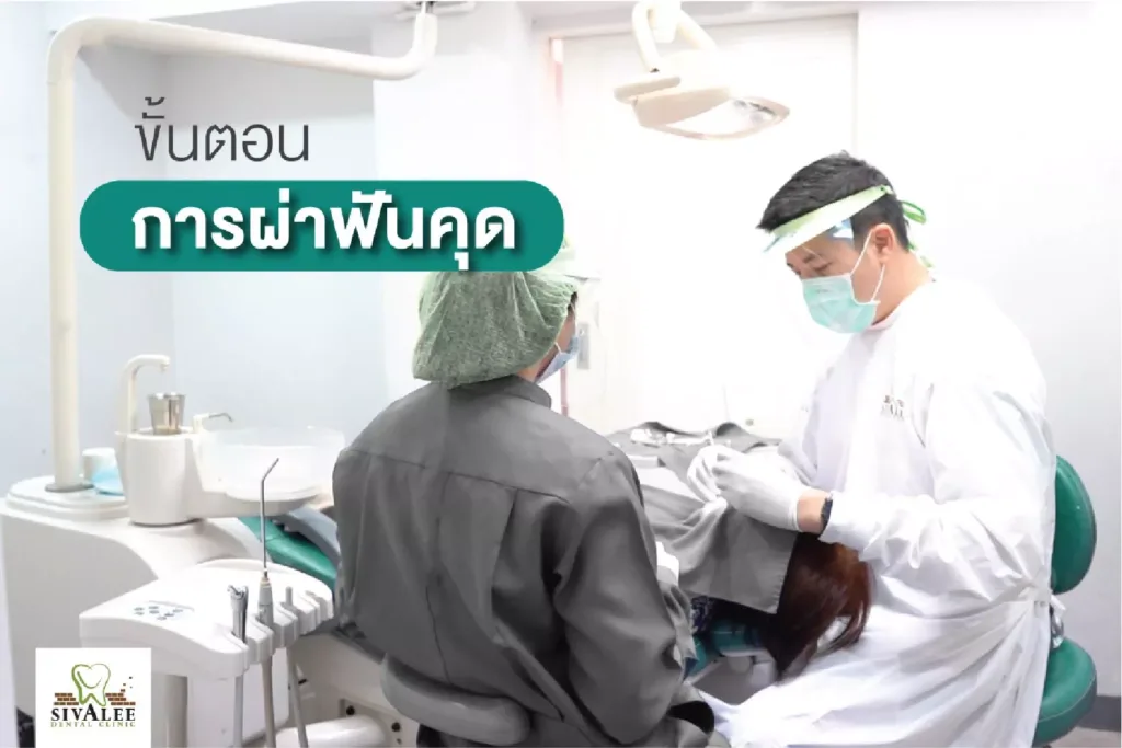 ขั้นตอนการผ่าฟันคุด