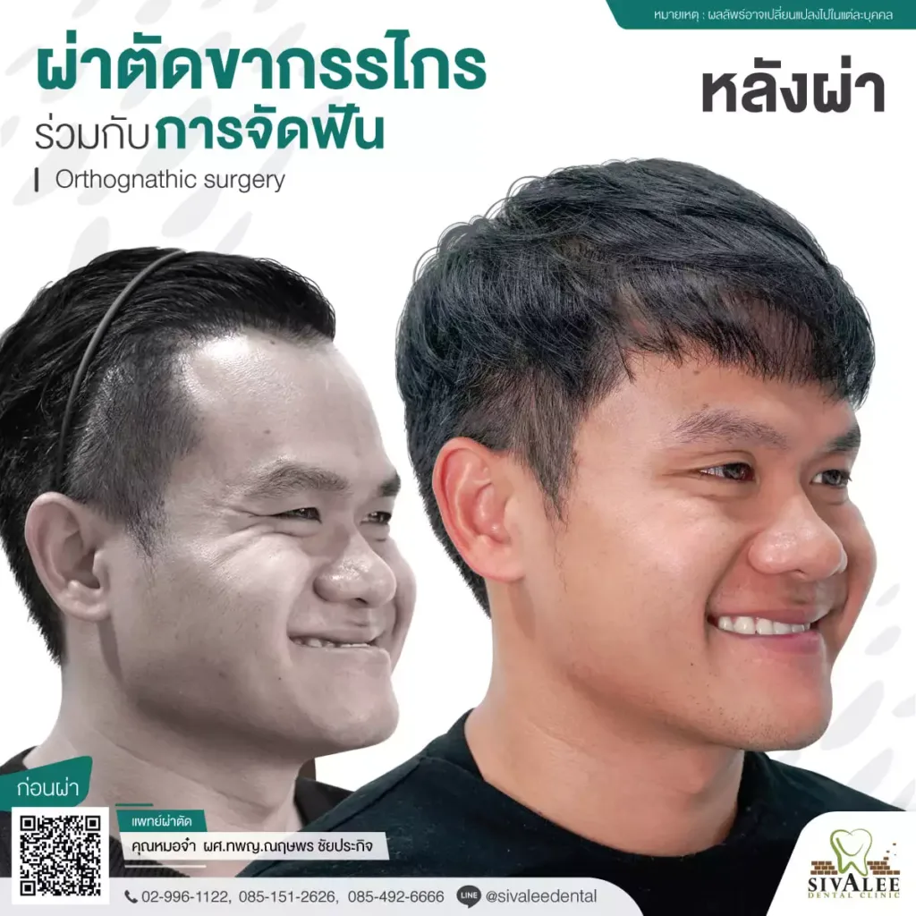 รีวิว คุณบี้ ผ่าตัดขากรรไกร