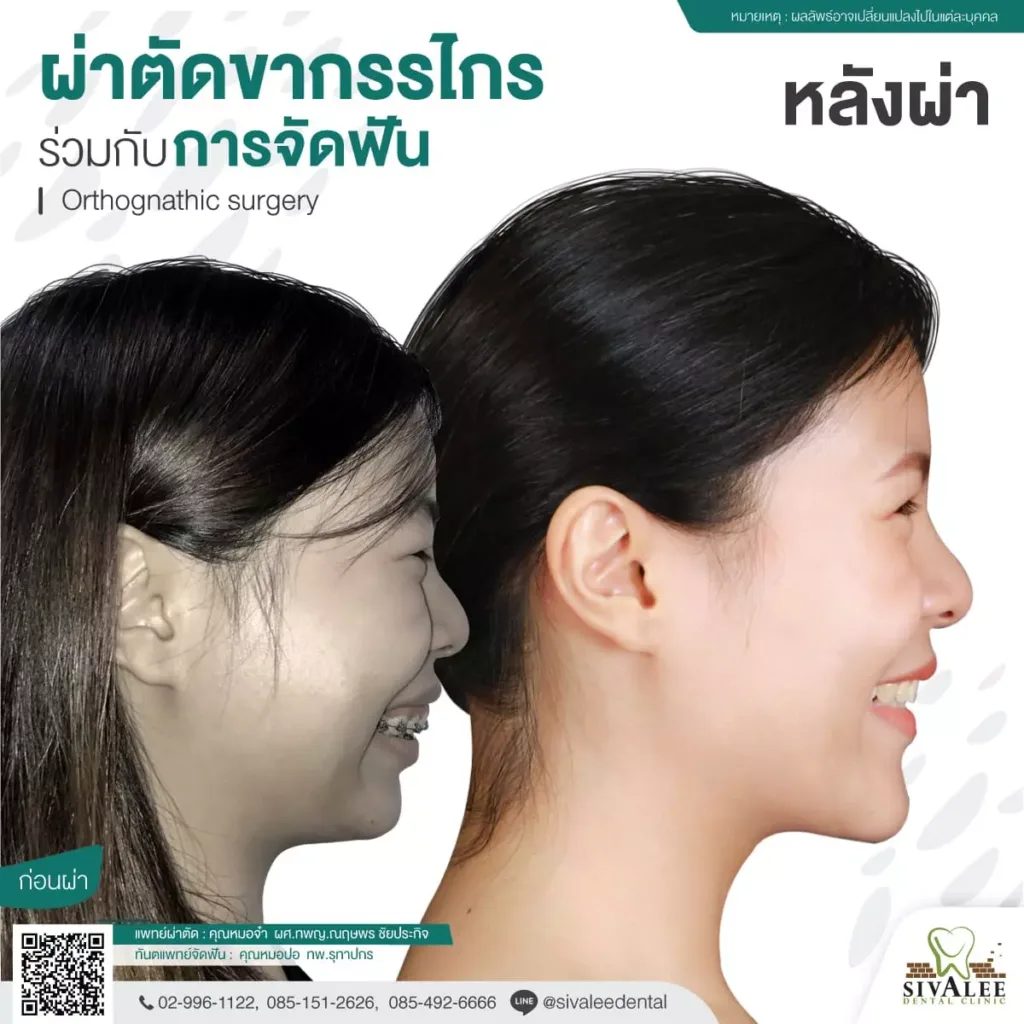 รีวิว ผ่าตัดขากรรไกร ด้านข้าง