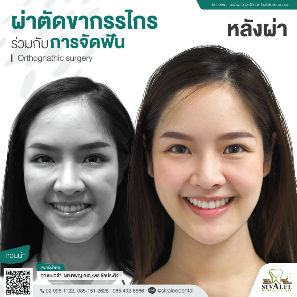 รีวิวผ่าตัดขากรรไกร