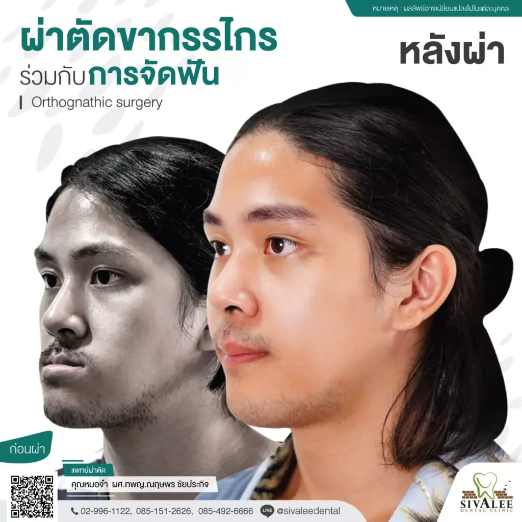 รีวิวผ่าตัดขากรรไกร จัดฟัน คุณกัน